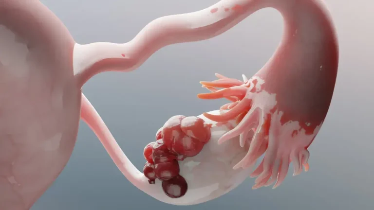 Digging Deeper: New Findings May Explain How Ovarian Cancer Really Starts