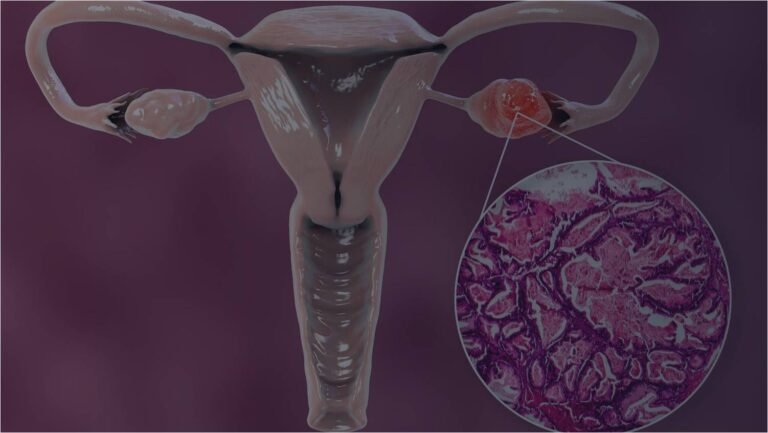 Folate Receptor Alpha: The Secret Weapon in Ovarian Cancer