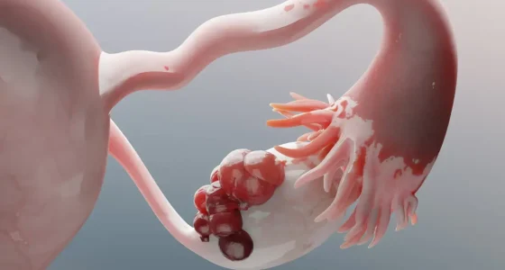 ovarian-tumor-1594194123